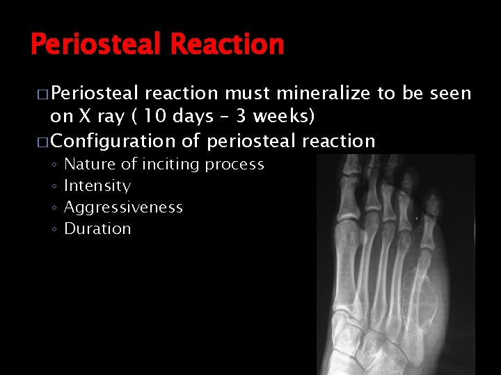 Periosteal Reaction � Periosteal reaction must mineralize to be seen on X ray (