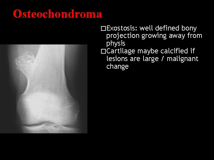 Osteochondroma �Exostosis: well defined bony projection growing away from physis �Cartilage maybe calcified if
