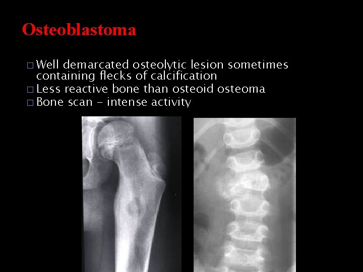 Osteoblastoma � Well demarcated osteolytic lesion sometimes containing flecks of calcification � Less reactive