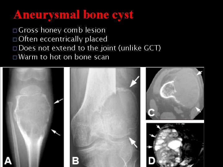 Aneurysmal bone cyst � Gross honey comb lesion � Often eccentrically placed � Does