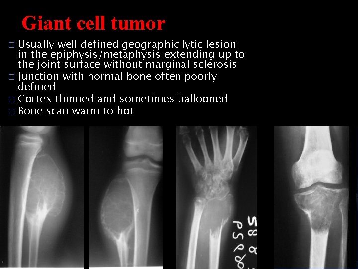 Giant cell tumor Usually well defined geographic lytic lesion in the epiphysis/metaphysis extending up