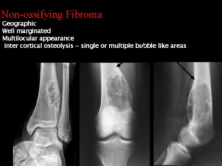 Non-ossifying Fibroma Geographic Well marginated Multilocular appearance Inter cortical osteolysis - single or multiple