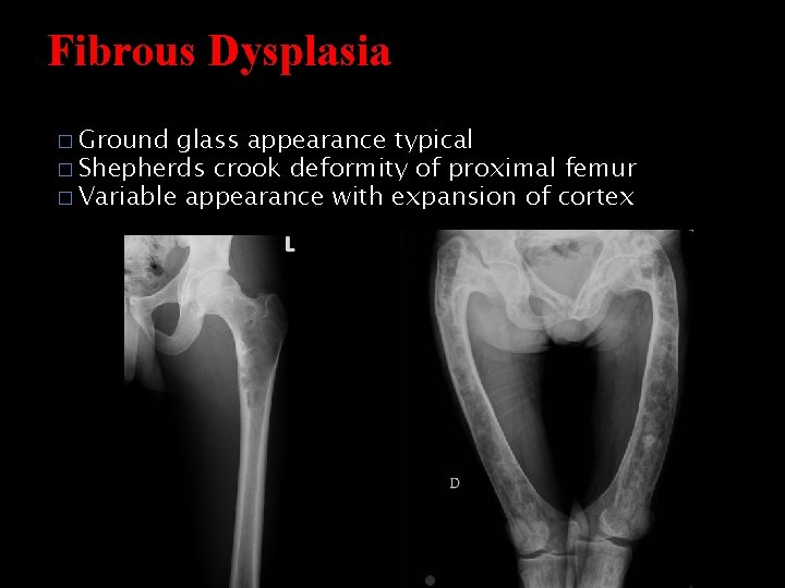 Fibrous Dysplasia � Ground glass appearance typical � Shepherds crook deformity of proximal femur