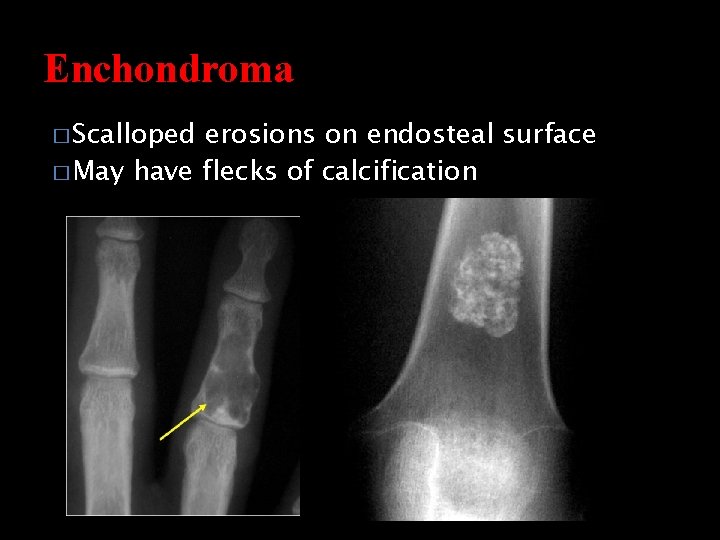 Enchondroma � Scalloped erosions on endosteal surface � May have flecks of calcification 