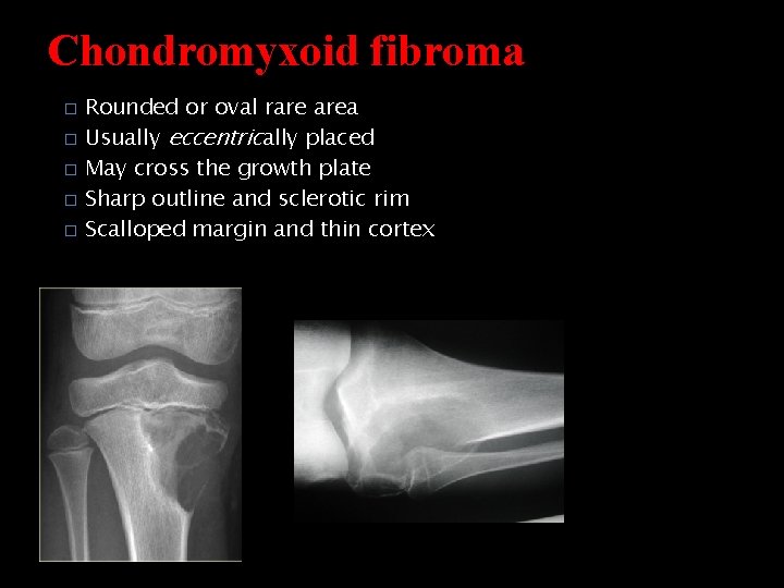 Chondromyxoid fibroma � � � Rounded or oval rare area Usually eccentrically placed May