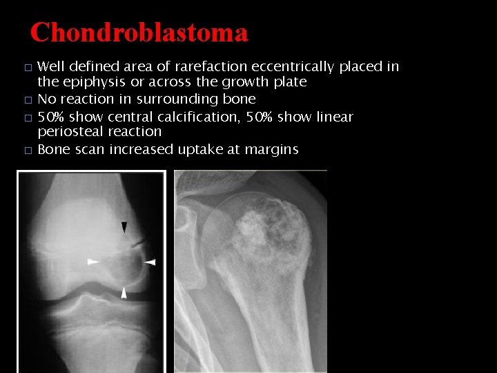 Chondroblastoma � � Well defined area of rarefaction eccentrically placed in the epiphysis or