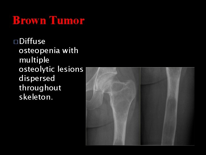 Brown Tumor � Diffuse osteopenia with multiple osteolytic lesions dispersed throughout skeleton. 