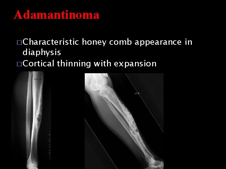 Adamantinoma � Characteristic honey comb appearance in diaphysis � Cortical thinning with expansion 