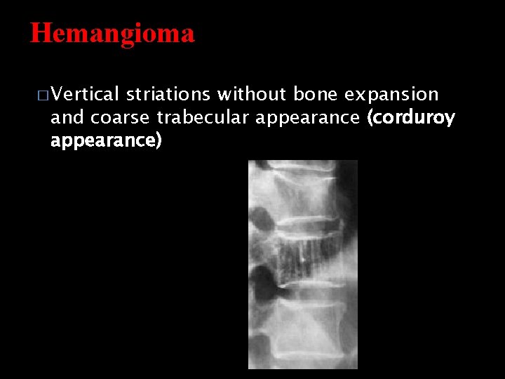 Hemangioma � Vertical striations without bone expansion and coarse trabecular appearance (corduroy appearance) 