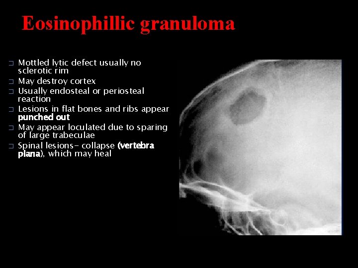 Eosinophillic granuloma � � � Mottled lytic defect usually no sclerotic rim May destroy