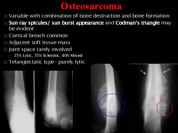 Osteosarcoma � � � Variable with combination of bone destruction and bone formation Sun