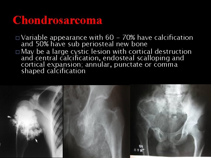 Chondrosarcoma � Variable appearance with 60 - 70% have calcification and 50% have sub