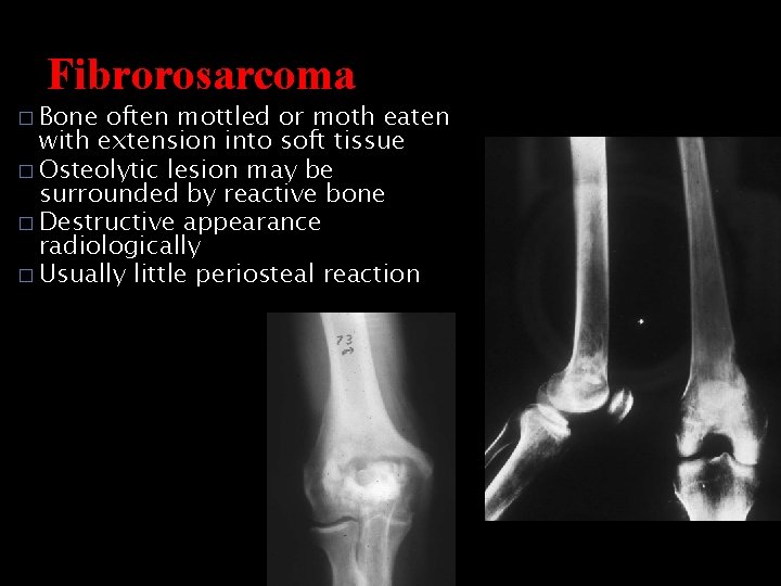 Fibrorosarcoma � Bone often mottled or moth eaten with extension into soft tissue �