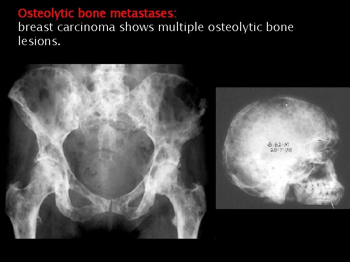 Osteolytic bone metastases: breast carcinoma shows multiple osteolytic bone lesions. 