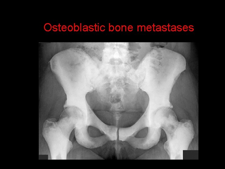 Osteoblastic bone metastases 
