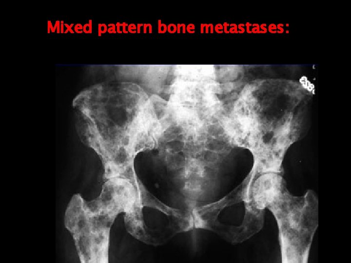 Mixed pattern bone metastases: 