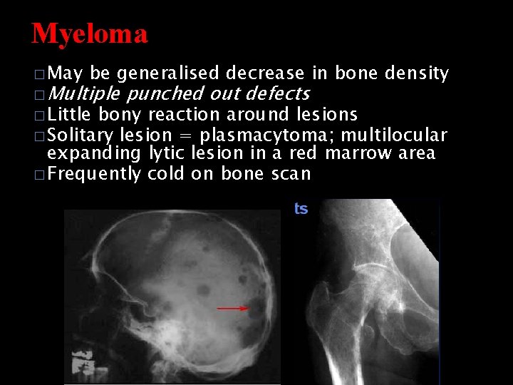 Myeloma � May be generalised decrease in bone density � Multiple � Little punched