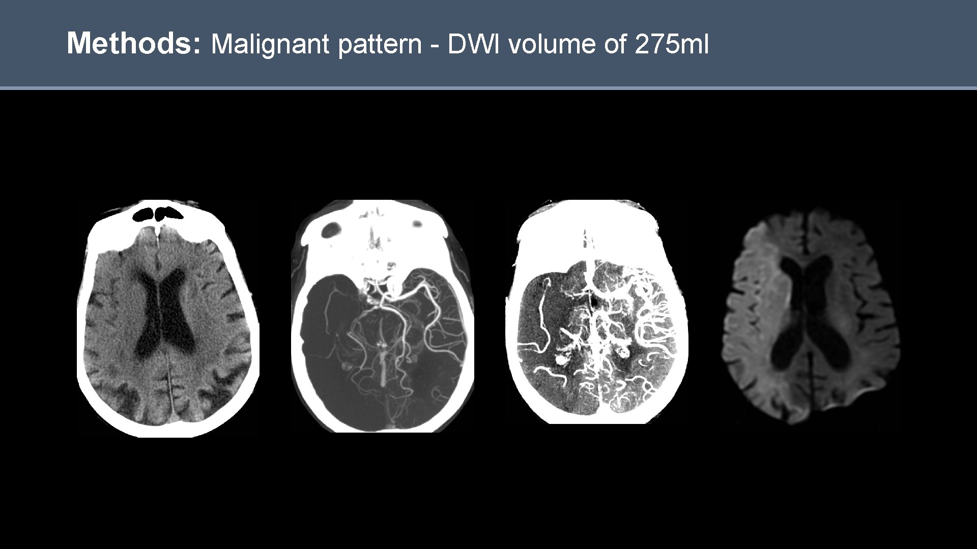 Methods: Malignant pattern - DWI volume of 275 ml 10 