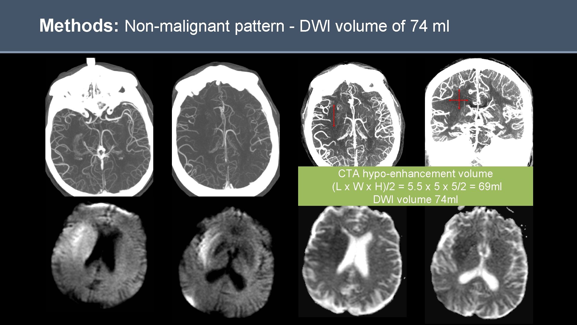 Methods: Non-malignant pattern - DWI volume of 74 ml CTA hypo-enhancement volume (L x