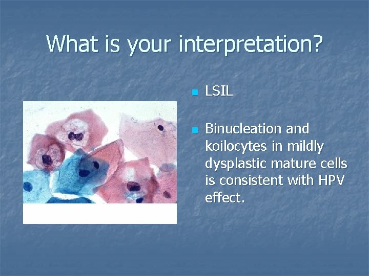 What is your interpretation? n n LSIL Binucleation and koilocytes in mildly dysplastic mature