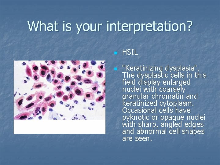 What is your interpretation? n n HSIL "Keratinizing dysplasia". The dysplastic cells in this