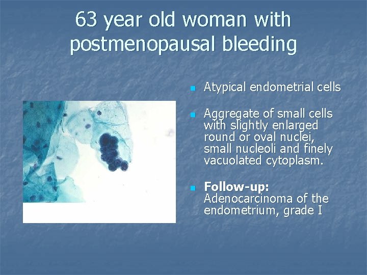 63 year old woman with postmenopausal bleeding n n n Atypical endometrial cells Aggregate