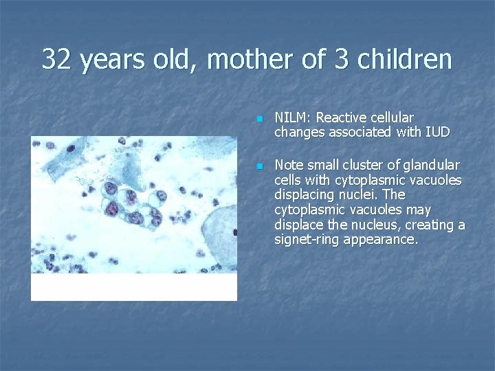 32 years old, mother of 3 children n n NILM: Reactive cellular changes associated