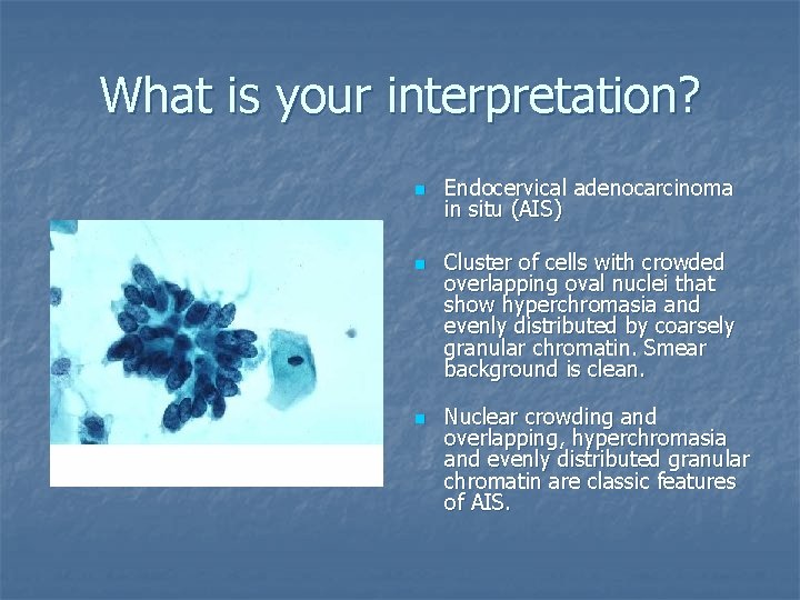 What is your interpretation? n n n Endocervical adenocarcinoma in situ (AIS) Cluster of