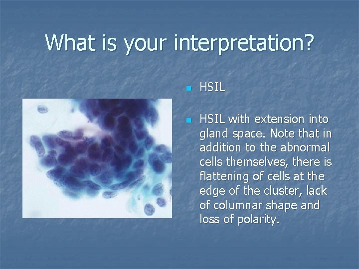 What is your interpretation? n n HSIL with extension into gland space. Note that