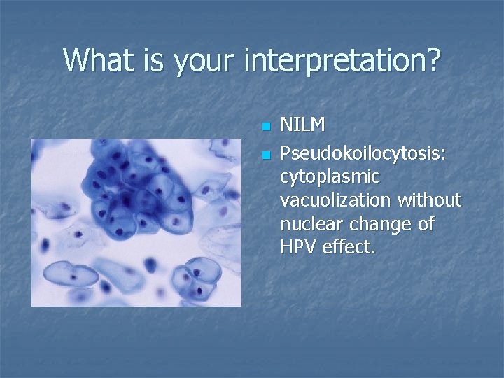 What is your interpretation? n n NILM Pseudokoilocytosis: cytoplasmic vacuolization without nuclear change of