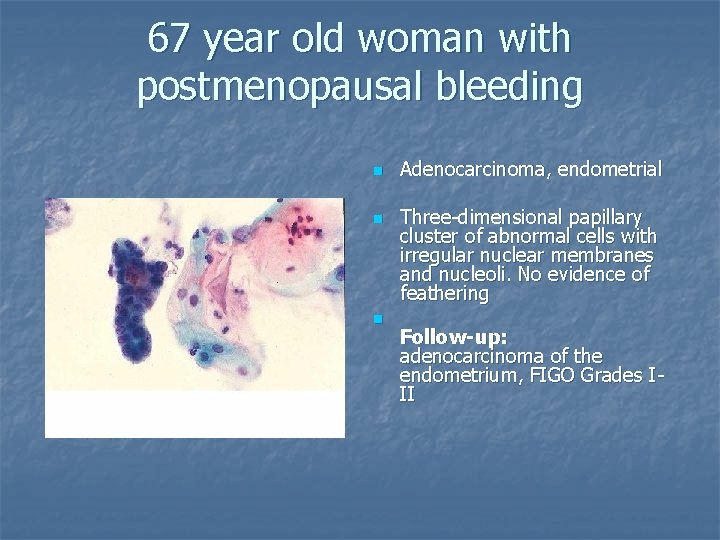 67 year old woman with postmenopausal bleeding n n n Adenocarcinoma, endometrial Three-dimensional papillary