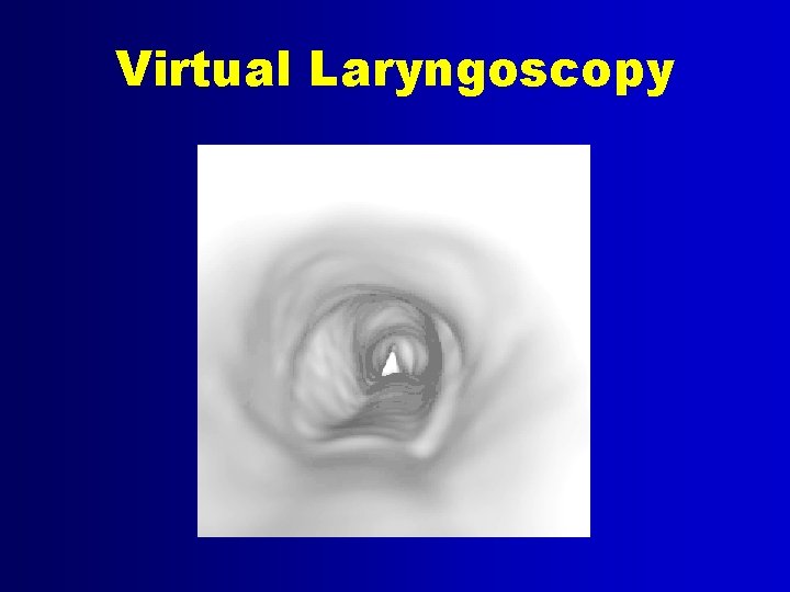 Virtual Laryngoscopy 