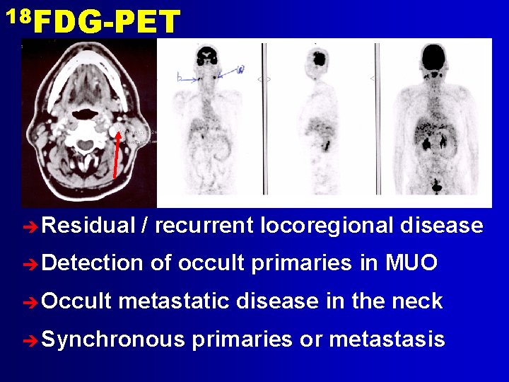 18 FDG-PET è Residual / recurrent locoregional disease è Detection è Occult of occult