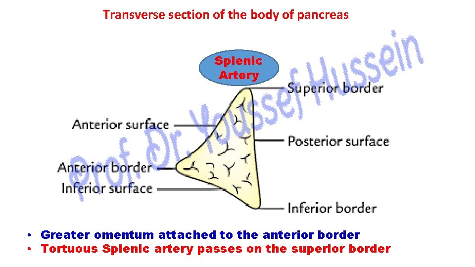 Transverse section of the body of pancreas Splenic Artery • Greater omentum attached to