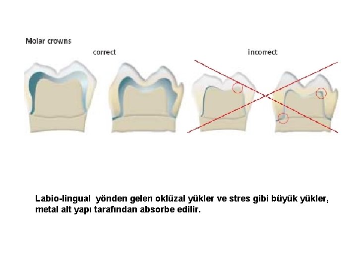 Labio-lingual yönden gelen oklüzal yükler ve stres gibi büyük yükler, metal alt yapı tarafından