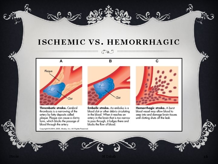 ISCHEMIC VS. HEMORRHAGIC Stroke M Dahab 16 