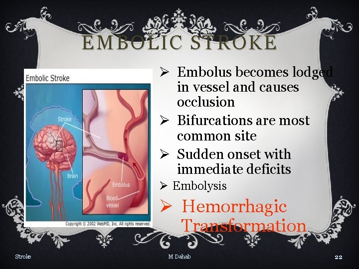 EMBOLIC STROKE Ø Embolus becomes lodged in vessel and causes occlusion Ø Bifurcations are