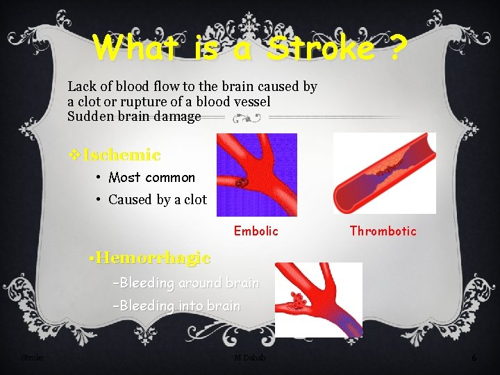 What is a Stroke ? Lack of blood flow to the brain caused by