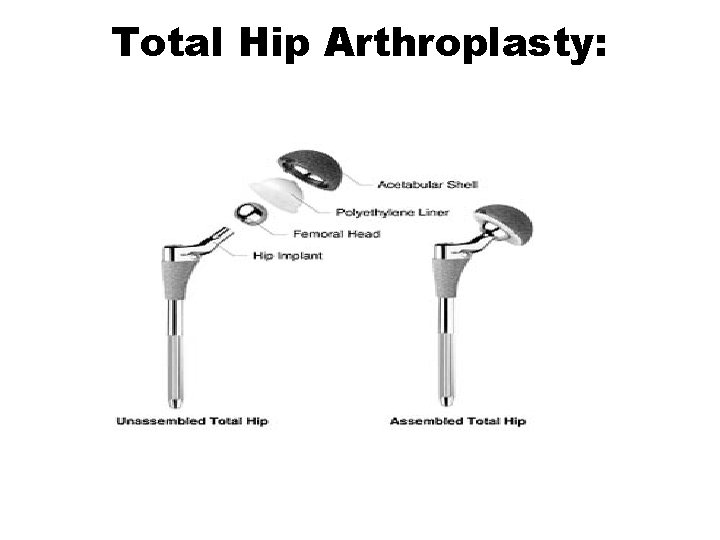 Total Hip Arthroplasty: 