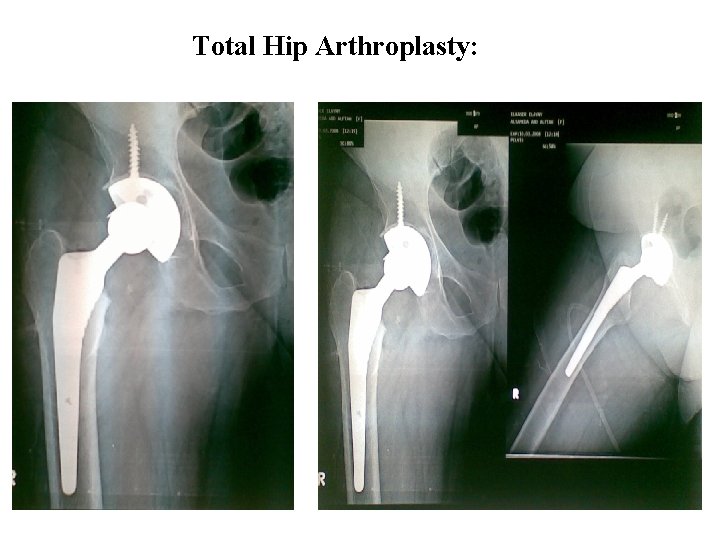 Total Hip Arthroplasty: 