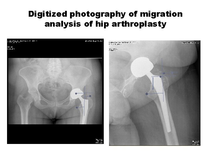 Digitized photography of migration analysis of hip arthroplasty 