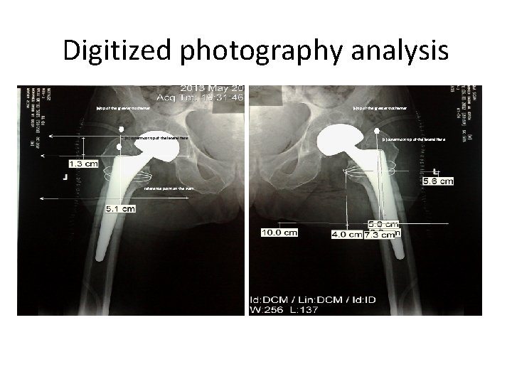 Digitized photography analysis (a)tip of the greater trochanter (b) outermost tip of the lateral