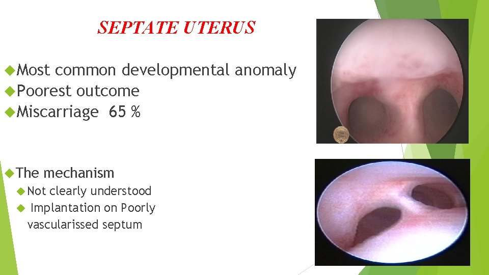 SEPTATE UTERUS Most common developmental anomaly Poorest outcome Miscarriage 65 % The mechanism Not