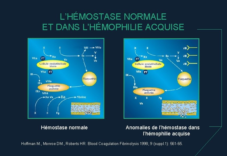 L’HÉMOSTASE NORMALE ET DANS L’HÉMOPHILIE ACQUISE Hémostase normale Anomalies de l’hémostase dans l’hémophilie acquise