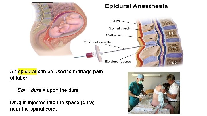An epidural can be used to manage pain of labor. Epi + dura =