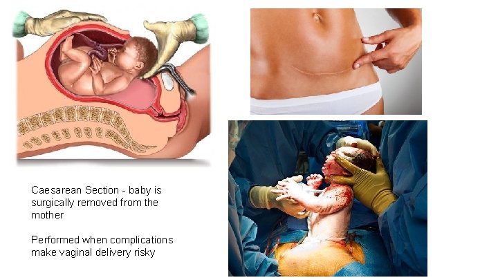 Caesarean Section - baby is surgically removed from the mother Performed when complications make