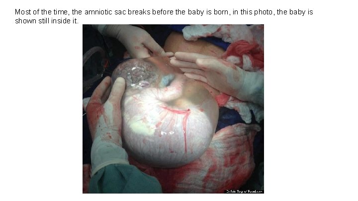 Most of the time, the amniotic sac breaks before the baby is born, in