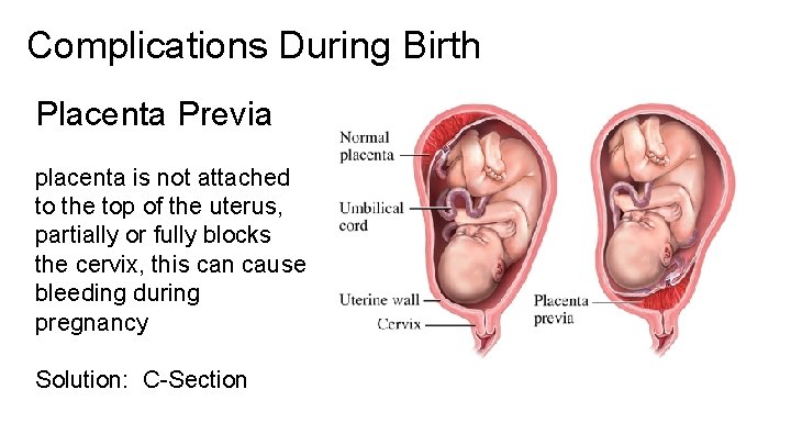 Complications During Birth Placenta Previa placenta is not attached to the top of the