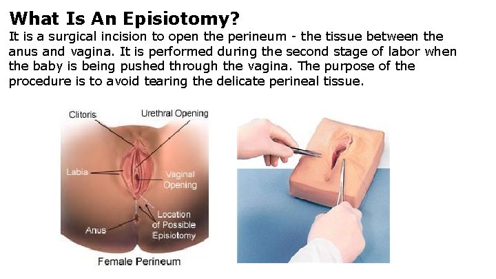 What Is An Episiotomy? It is a surgical incision to open the perineum -