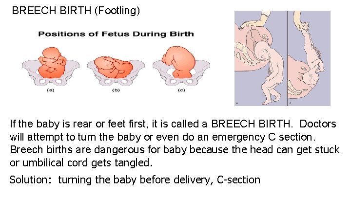 BREECH BIRTH (Footling) If the baby is rear or feet first, it is called
